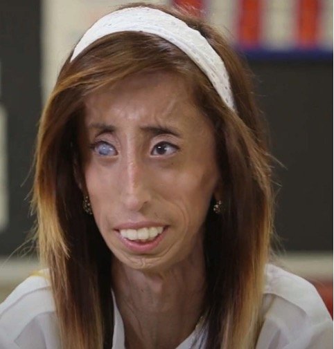 Lizzie Velasquez 11